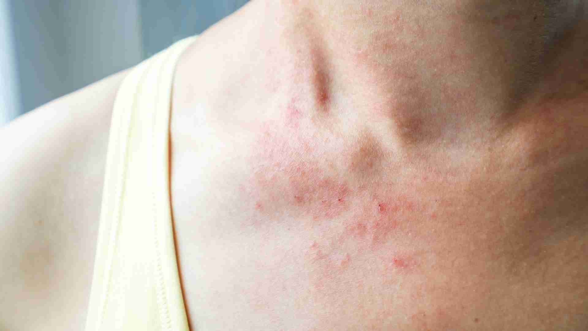 Woman with eczema and redness