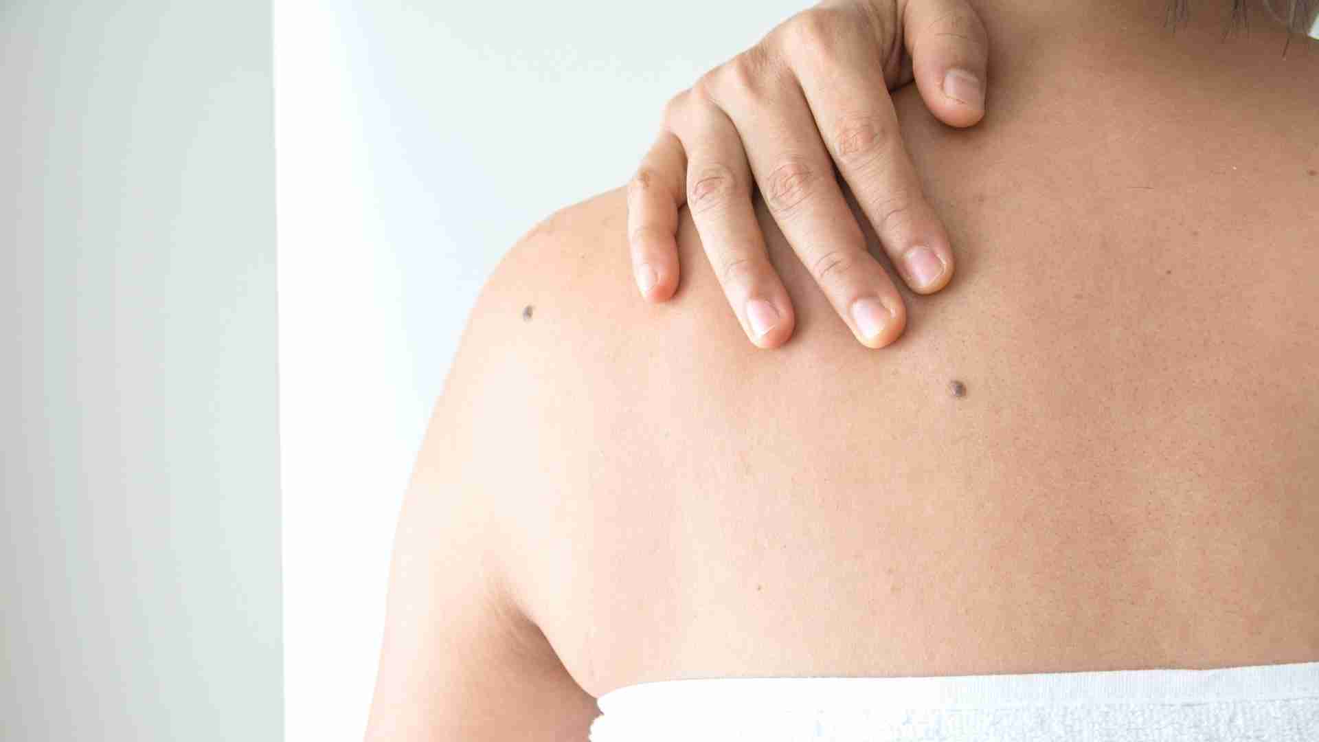Woman with back moles and brown spots